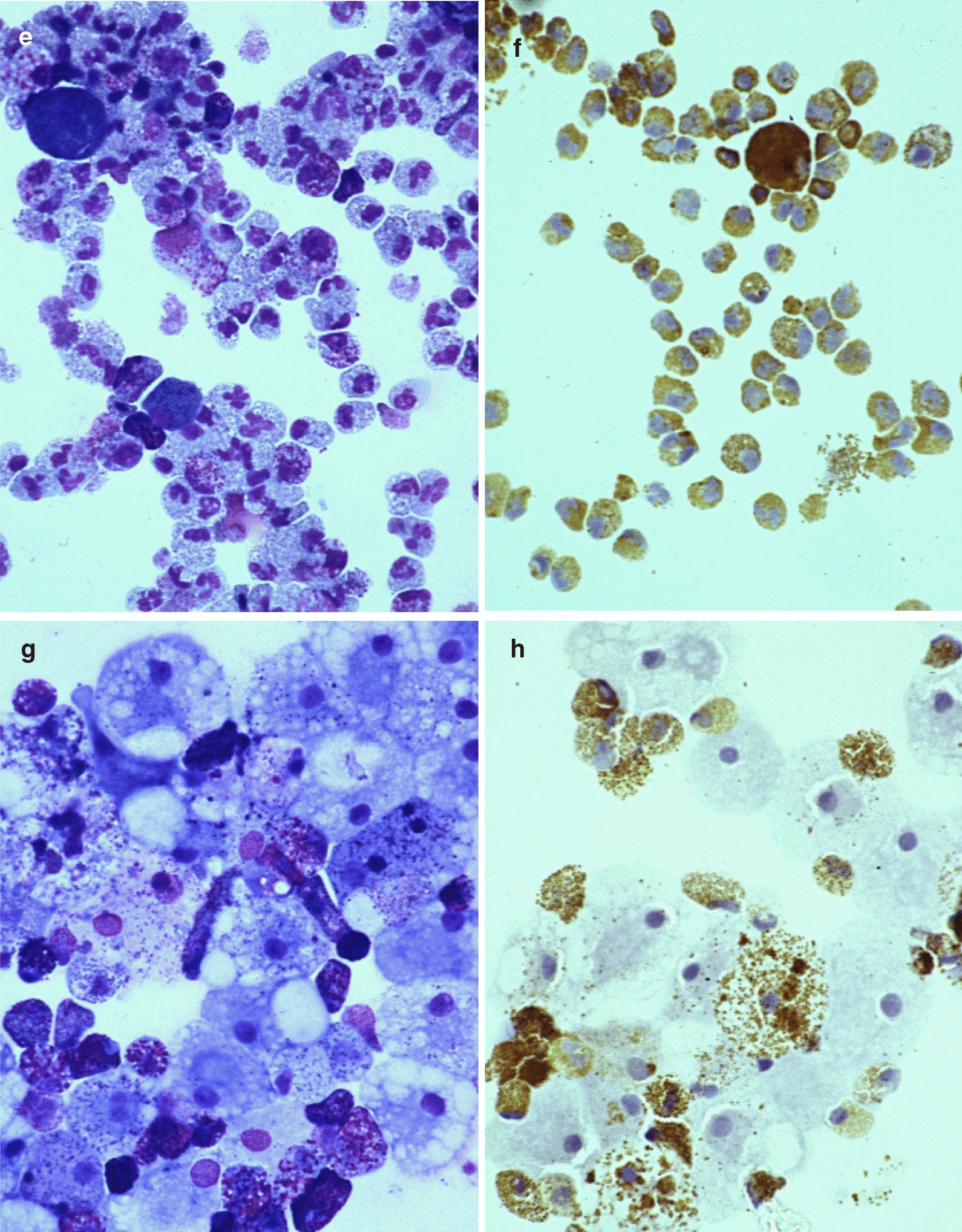 Dexamethasone and lidocaine suppress eosinophilopoiesis from umbilical cord blood cells.