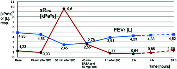 Severe bronchial reaction to provocation with fish and crustaceans.