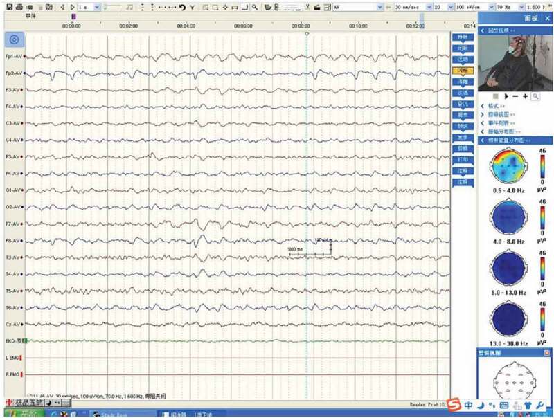 Rare genetic E196A mutation in a patient with Creutzfeldt-Jakob disease: a case report and literature.