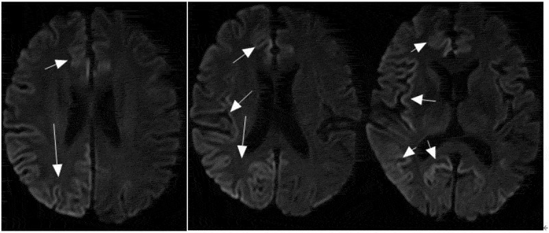 Rare genetic E196A mutation in a patient with Creutzfeldt-Jakob disease: a case report and literature.