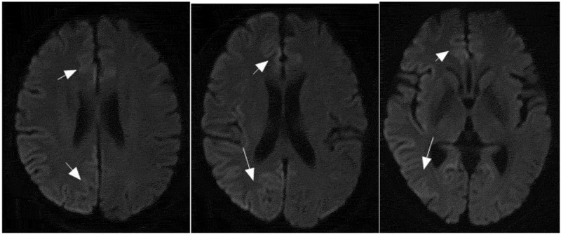 Rare genetic E196A mutation in a patient with Creutzfeldt-Jakob disease: a case report and literature.