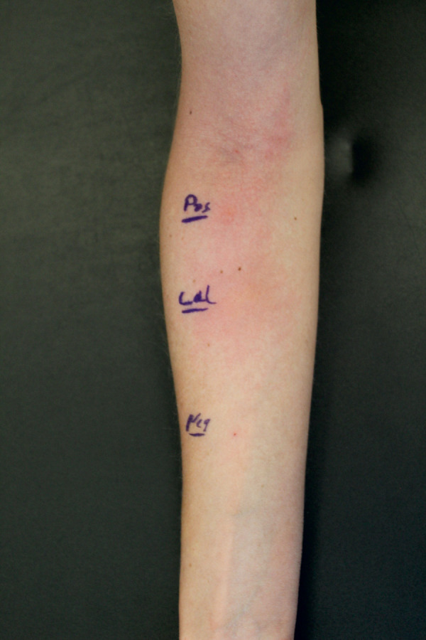 Occupational allergic contact urticaria to tropomyosin from squid.