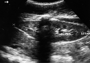 Acute kidney failure following severe viper envenomation: clinical, biological and ultrasonographic aspects.