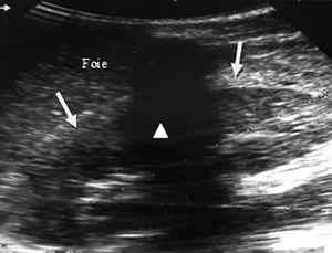 Acute kidney failure following severe viper envenomation: clinical, biological and ultrasonographic aspects.