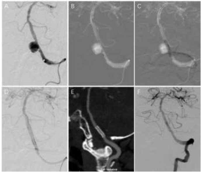 Reconstructive treatment of symptomatic vertebral artery dissecting aneurysms with Willis covered stent: Initial experience