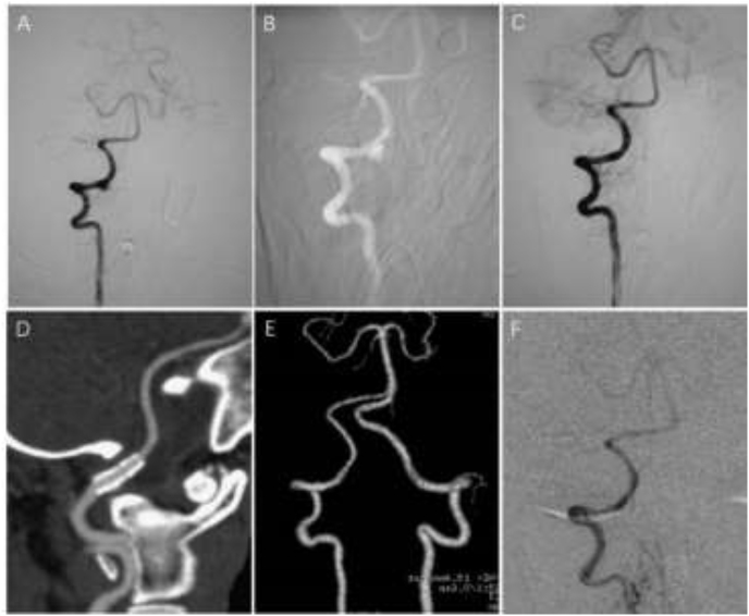 Reconstructive treatment of symptomatic vertebral artery dissecting aneurysms with Willis covered stent: Initial experience