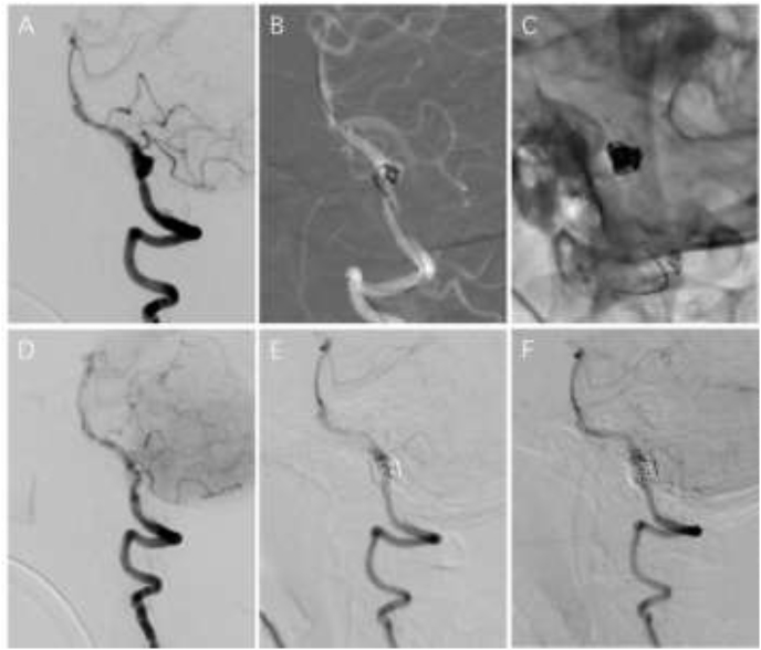 Reconstructive treatment of symptomatic vertebral artery dissecting aneurysms with Willis covered stent: Initial experience