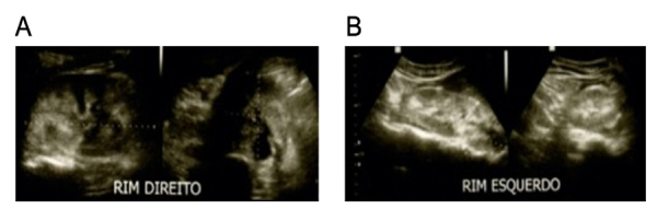 Chronic kidney failure following lancehead bite envenoming: a clinical report from the Amazon region.