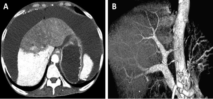 Liver Infarction and Venous Thromboembolism after Tamoxifen Use in an ADPKD Patient with Encapsulating Peritoneal Sclerosis: A Case Report.