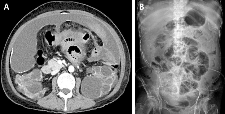 Liver Infarction and Venous Thromboembolism after Tamoxifen Use in an ADPKD Patient with Encapsulating Peritoneal Sclerosis: A Case Report.