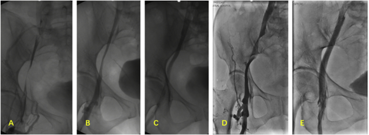 Endovascular stent treatment of the iliac vein stenosis caused by a pelvic lymphocele secondary to gynecologic malignancy