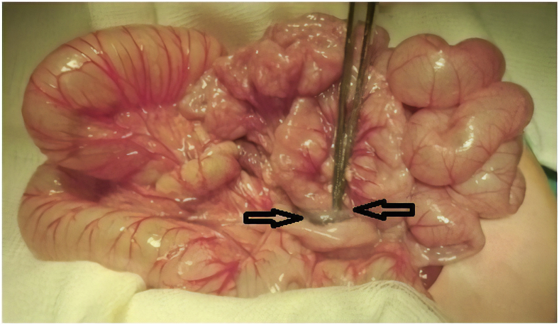 Idiopathic congenital anomalous bands: About ten cases with systematic review of the literature