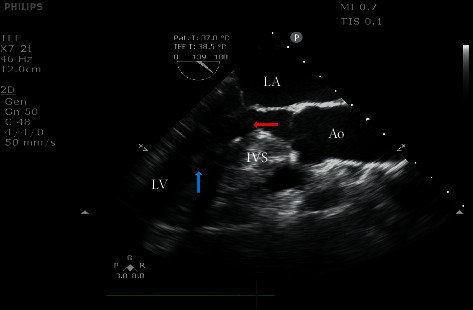 Characteristics and Surgical Results of Patients with Hypertrophic Obstructive Cardiomyopathy without Intrinsic Mitral Valve Diseases Undergoing Mitral Subvalvular Procedures during Myectomy.