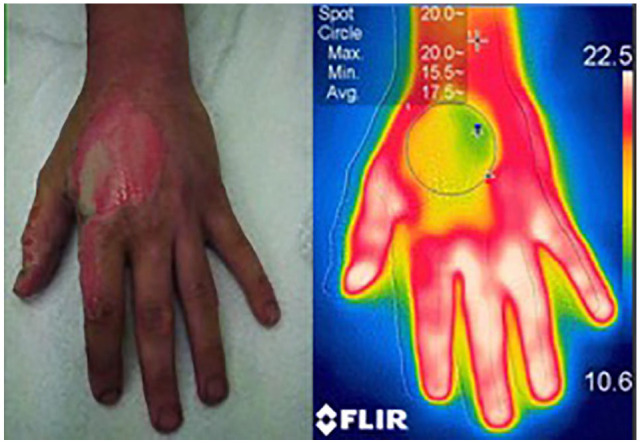 A prospective study comparing the FLIR ONE with laser Doppler imaging in the assessment of burn depth by a tertiary burns unit in the United Kingdom.