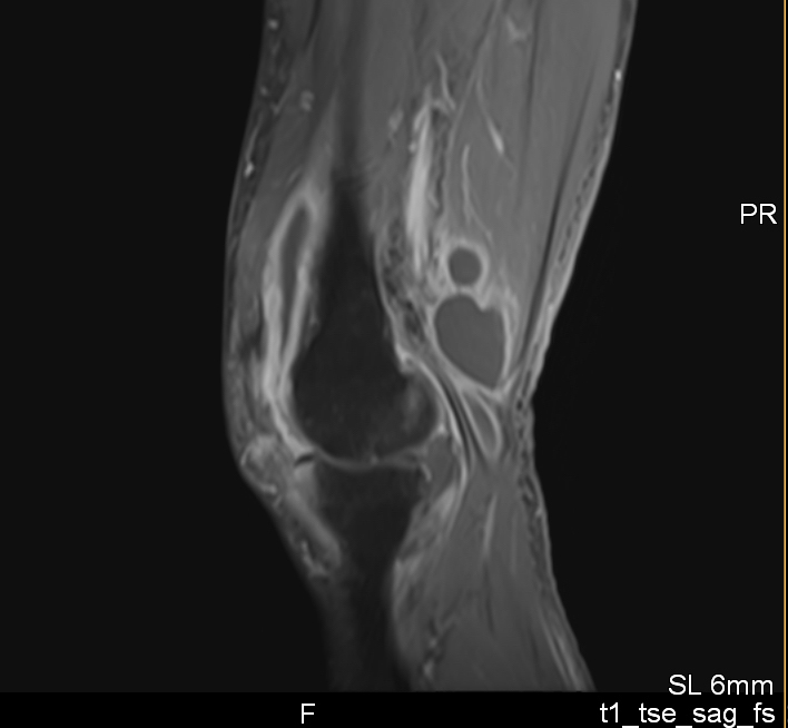 Septic arthritis of the knee due to <i>Pantoea</i> <i>agglomerans</i>: look for the thorn.