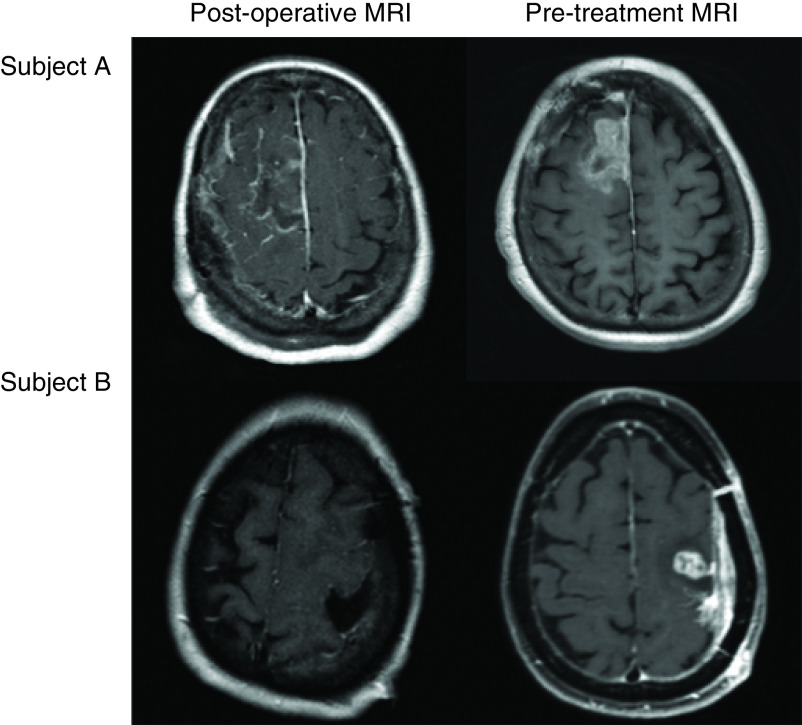 Time to treatment initiation and outcomes in high-grade glioma patients in rehabilitation: a retrospective cohort study.