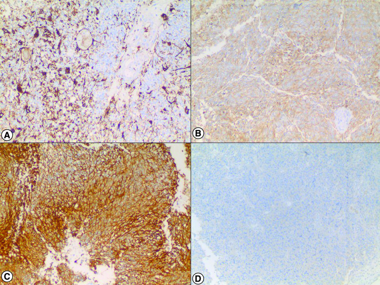 Small cell glioblastoma multiforme: a case series and clinicopathological update.