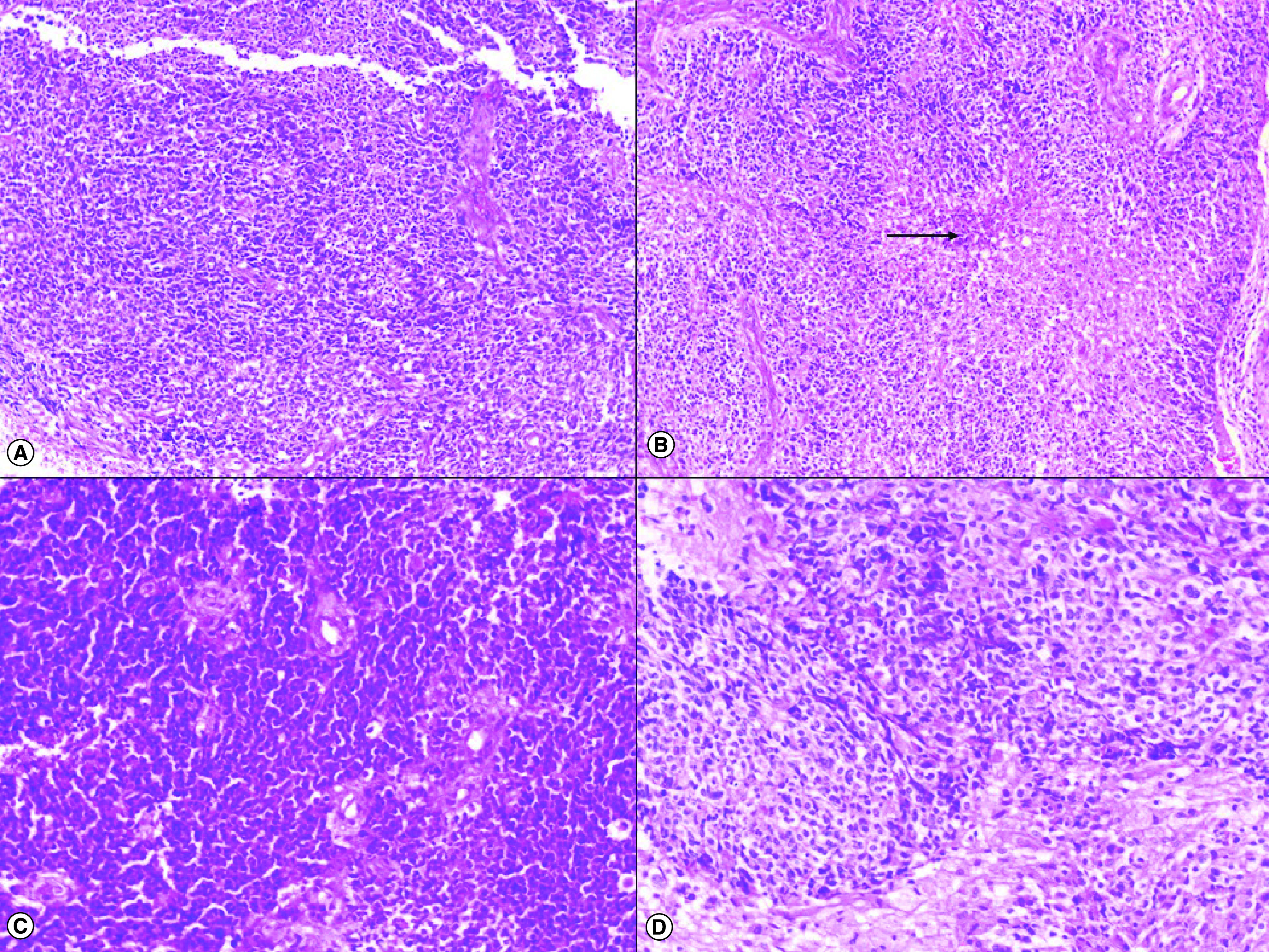 Small cell glioblastoma multiforme: a case series and clinicopathological update.