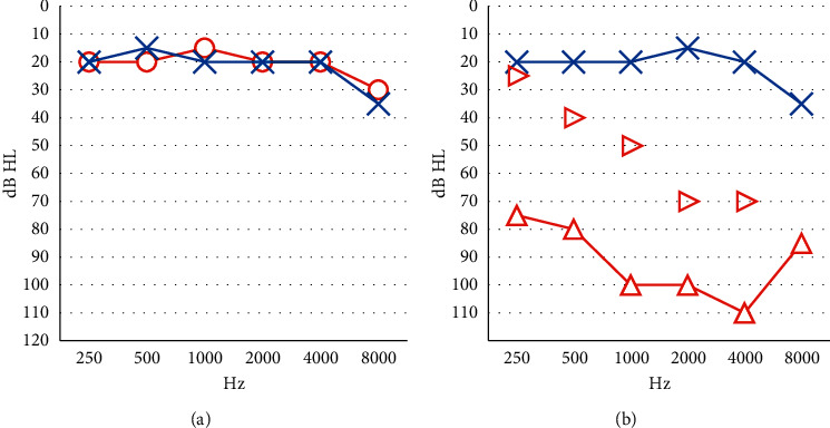 Middle Ear Neuroendocrine Adenoma: A Case Report and Literature Review.