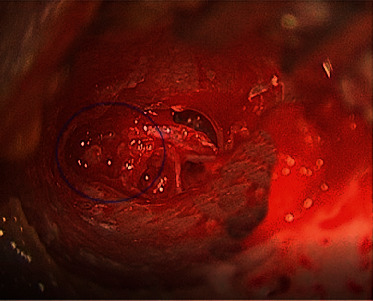 Middle Ear Neuroendocrine Adenoma: A Case Report and Literature Review.