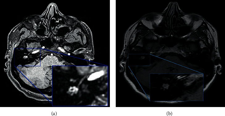 Middle Ear Neuroendocrine Adenoma: A Case Report and Literature Review.