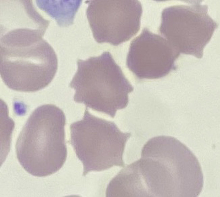 Infantile Pyknocytosis: End-Tidal CO, %Micro-R Measurements, Next-Generation Sequencing, and Transfusion Avoidance with Darbepoetin.