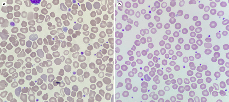 Infantile Pyknocytosis: End-Tidal CO, %Micro-R Measurements, Next-Generation Sequencing, and Transfusion Avoidance with Darbepoetin.