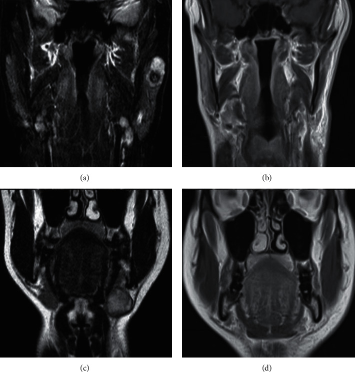 Synchronous Ipsilateral Pleomorphic Adenomas of Parotid and Submandibular Glands: An Unusual Finding.