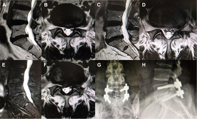 Comparison of Percutaneous Endoscopic Lumbar Discectomy with Minimally Invasive Transforaminal Lumbar Interbody Fusion as a Revision Surgery for Recurrent Lumbar Disc Herniation after Percutaneous Endoscopic Lumbar Discectomy.