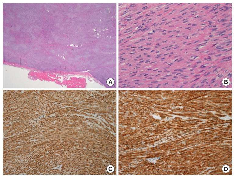 Perianal extragastrointestinal stromal tumor.