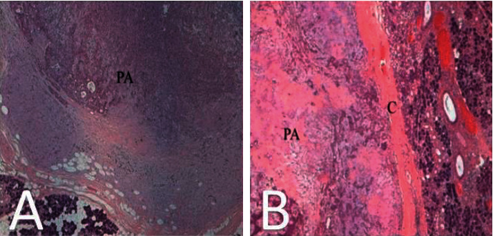 Synchronous Ipsilateral Pleomorphic Adenomas of Parotid and Submandibular Glands: An Unusual Finding.