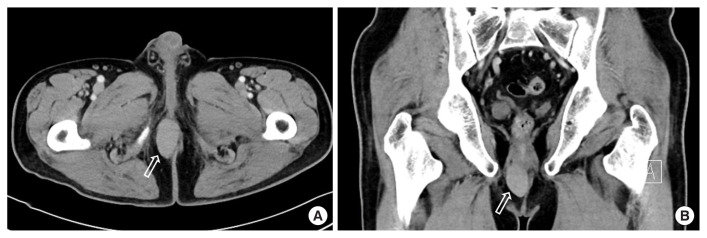 Perianal extragastrointestinal stromal tumor.