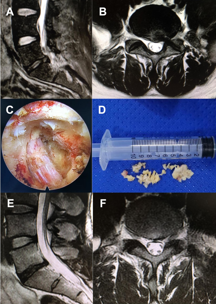 Comparison of Percutaneous Endoscopic Lumbar Discectomy with Minimally Invasive Transforaminal Lumbar Interbody Fusion as a Revision Surgery for Recurrent Lumbar Disc Herniation after Percutaneous Endoscopic Lumbar Discectomy.