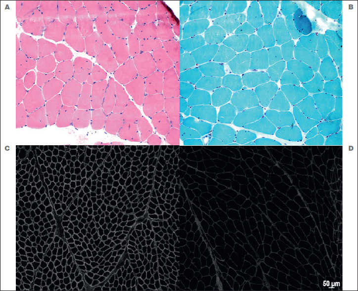 Alpha-sarcoglycanopathy presenting as myalgia and hyperCKemia in two adults with a long-term follow-up. Case reports.