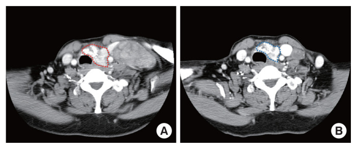 Thyrotropin suppression therapy for papillary thyroid carcinoma with a huge recurred neck lymph node.