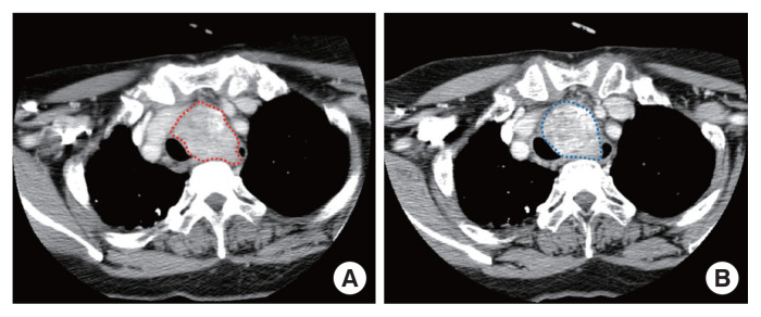 Thyrotropin suppression therapy for papillary thyroid carcinoma with a huge recurred neck lymph node.