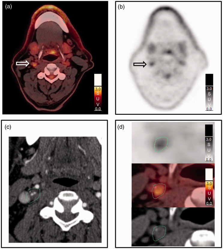 Inter-reader agreement of <sup>18</sup>F-FDG PET/CT for the quantification of carotid artery plaque inflammation.