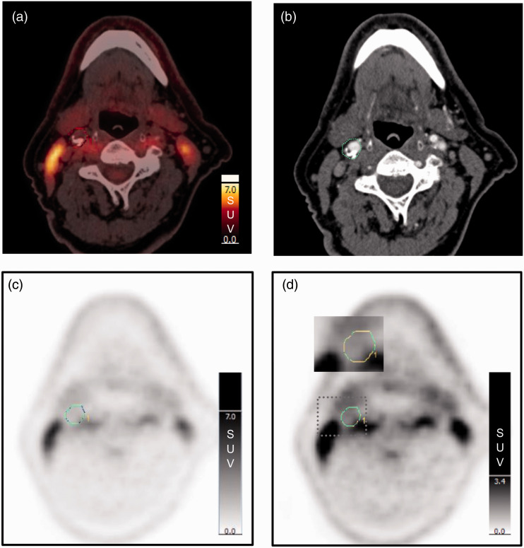 Inter-reader agreement of <sup>18</sup>F-FDG PET/CT for the quantification of carotid artery plaque inflammation.