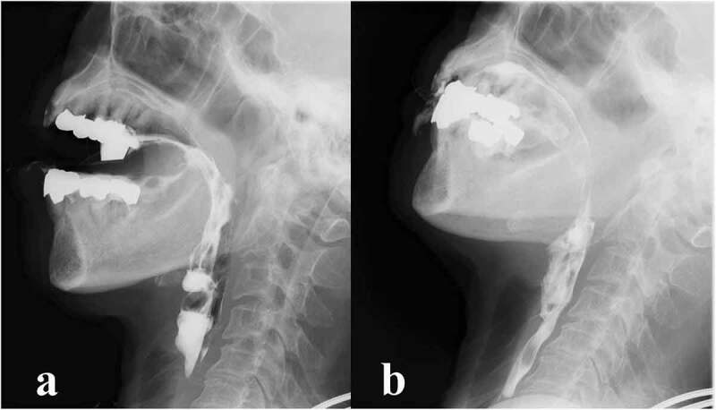 Serial evaluation of swallowing function in a long-term survivor of V180I genetic Creutzfeldt-Jakob disease.