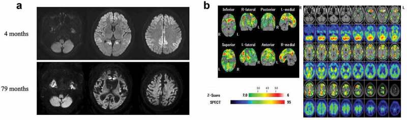 Serial evaluation of swallowing function in a long-term survivor of V180I genetic Creutzfeldt-Jakob disease.