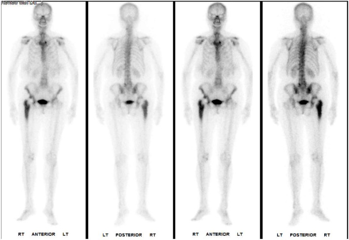 A case of <i>Trueperella pyogenes</i> causing prosthetic joint infection.