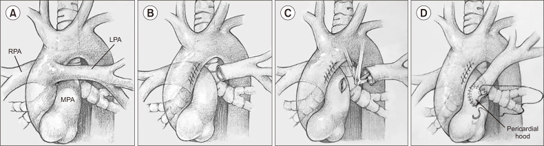 Left Hemitruncus Treated Along with Ventricular Septal Defect in a Neonate.