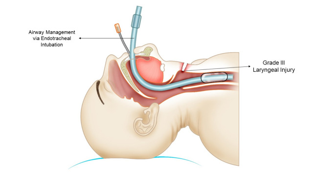 Damage control of laryngotracheal trauma: the golden day.