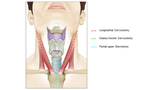 Damage control of laryngotracheal trauma: the golden day.