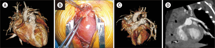 Left Hemitruncus Treated Along with Ventricular Septal Defect in a Neonate.