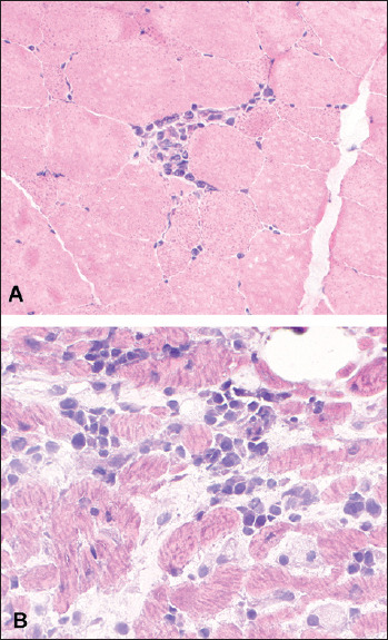 The correlation between cardiac and skeletal muscle pathology in animal models of idiopathic inflammatory myopathies.