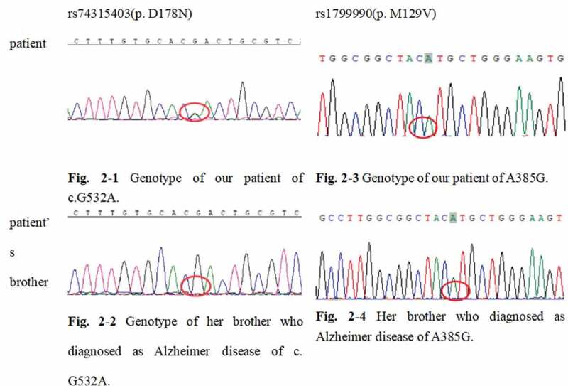 Corticobasal manifestations of Creutzfeldt-Jakob disease with D178N-homozygous 129M genotype.