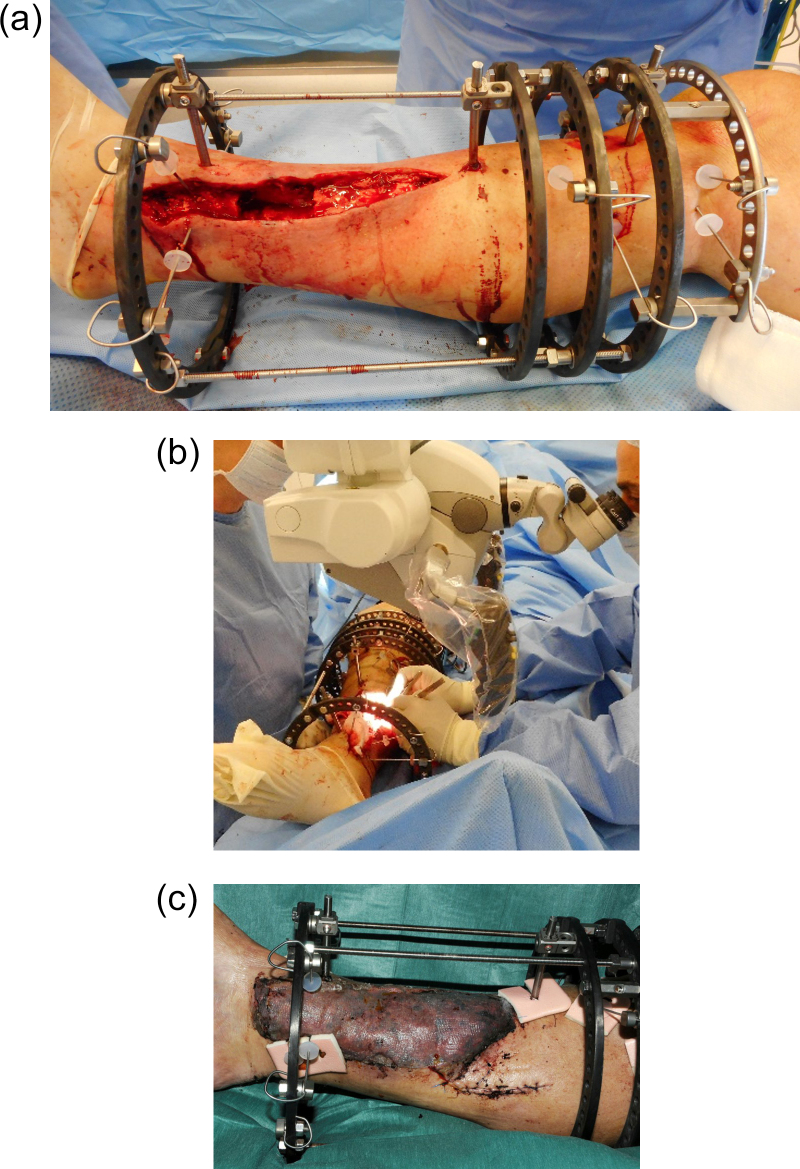 Simultaneous debridement, Ilizarov reconstruction and free muscle flaps in the management of complex tibial infection.