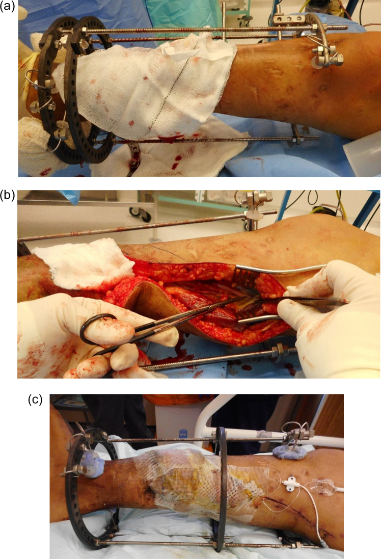 Simultaneous debridement, Ilizarov reconstruction and free muscle flaps in the management of complex tibial infection.