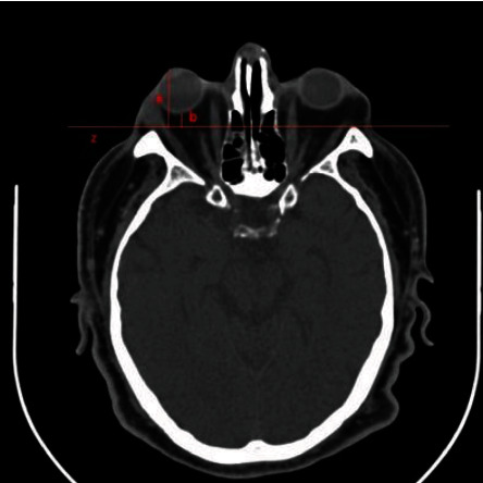 Proptosis with Increased Orbital Fat in an Obese Patient.